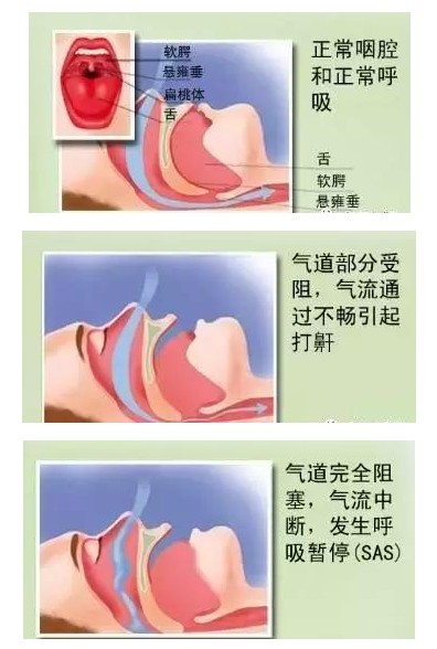 呼吸機(jī)可以完全治愈睡眠呼吸暫停嗎？